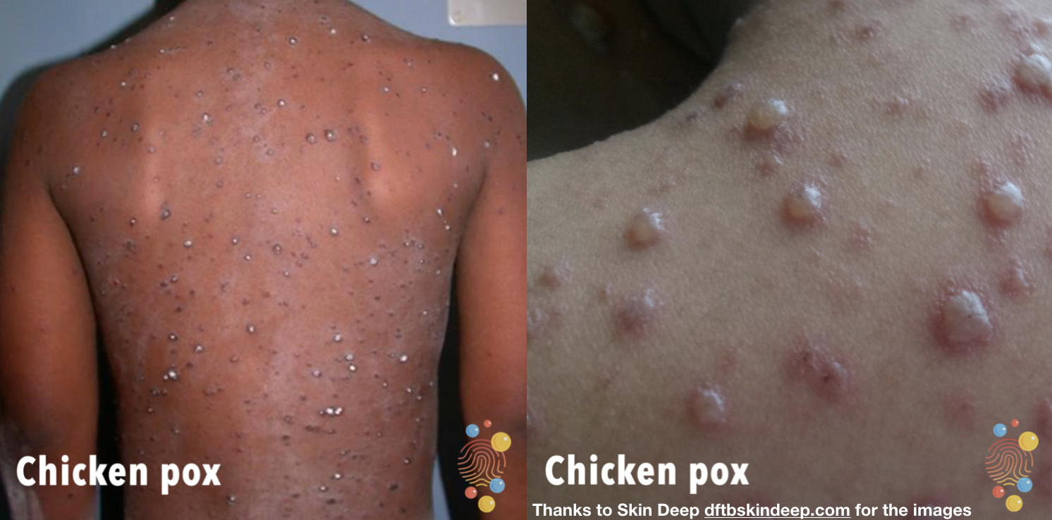 Chickenpox West Yorkshire Healthier Together