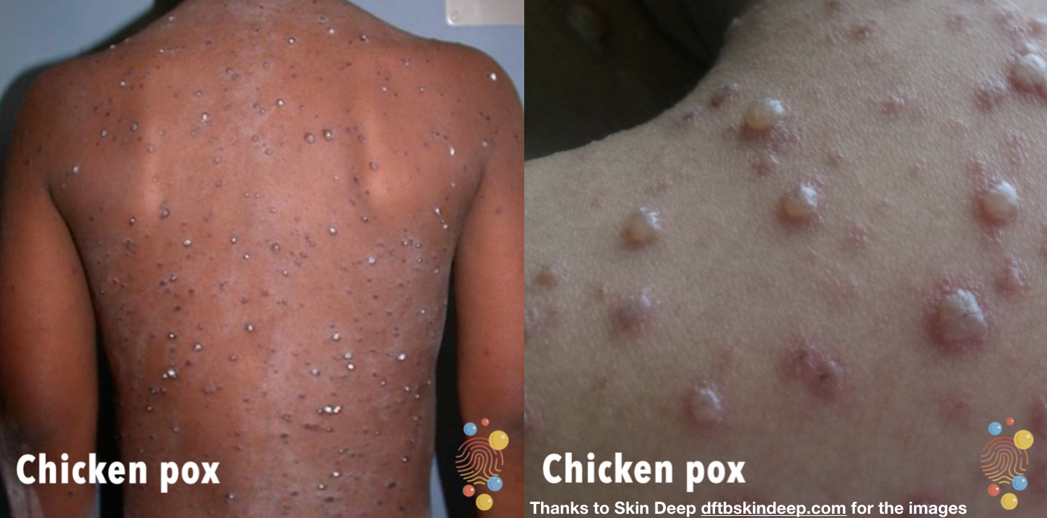 chickenpox-rash