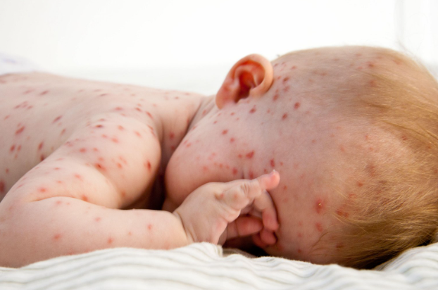 Rashes & spots (pictures) in toddlers, children & babies - NHS doctor  identified