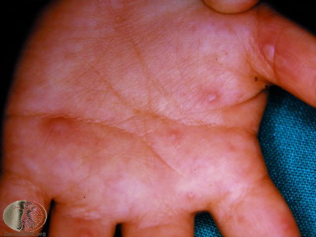 Hand foot and mouth rash.jpg