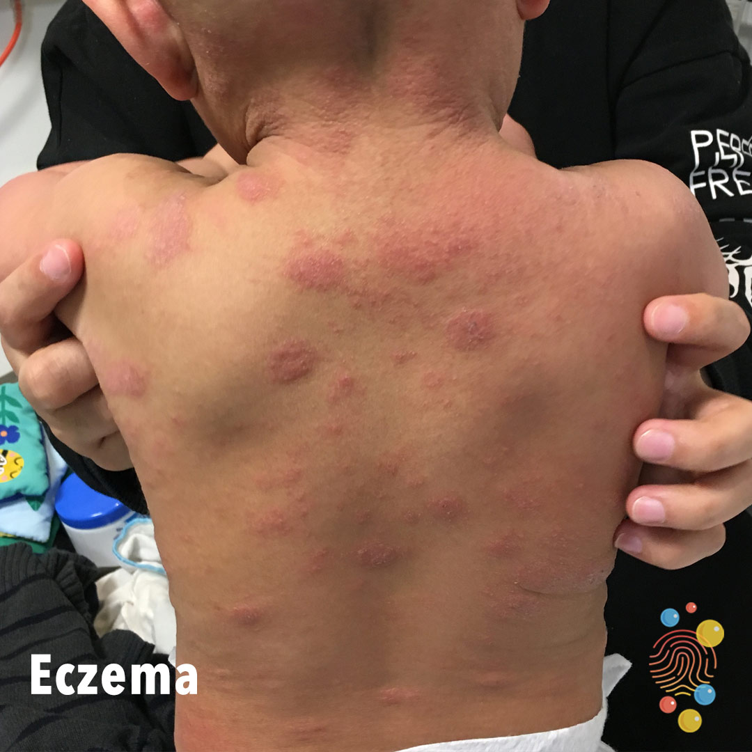 Eczema shown as red blotches on a young child's back