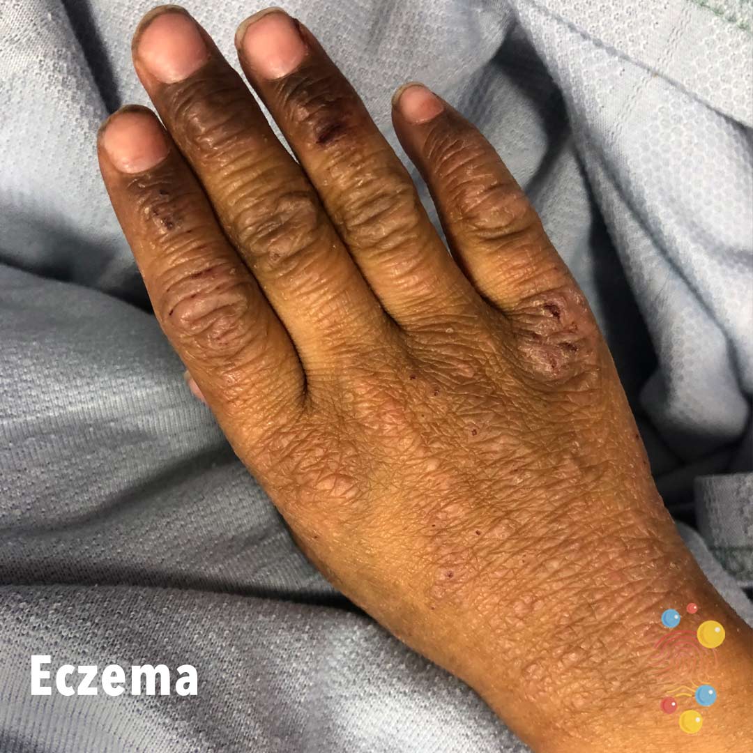 15-eczema.jpg