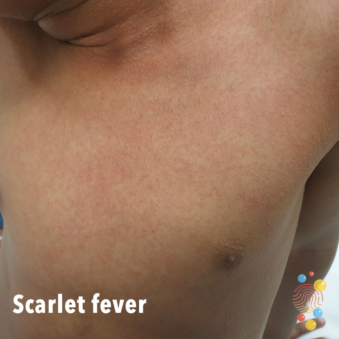 What dental teams need to know about scarlet fever