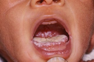 oral thrush in babies.jpg
