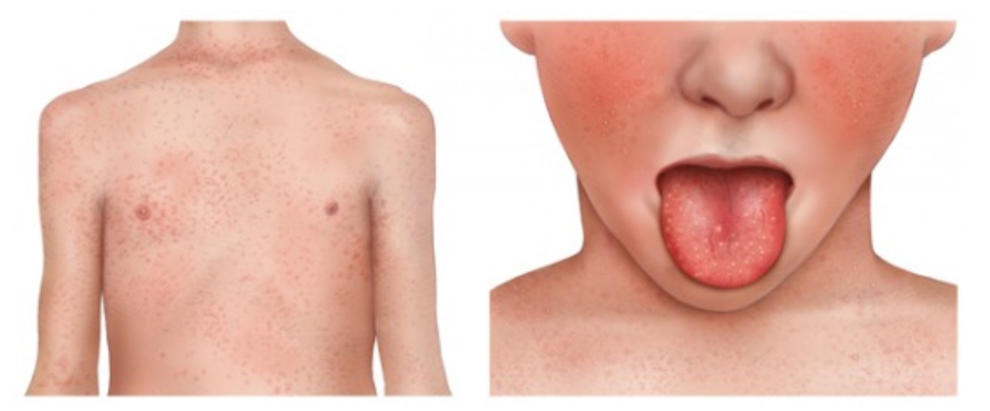 Strep A and Scarlet Fever - King's Medical Centre