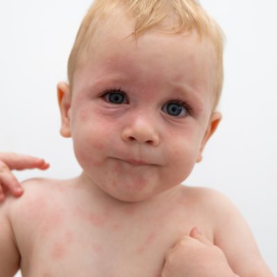 Allergic Reactions :: West Yorkshire Healthier Together